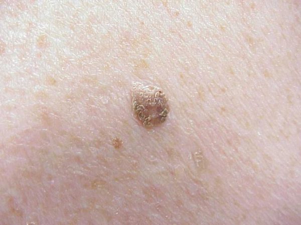 Skin Cancers And Lesions – The Skin Cancer Doctor