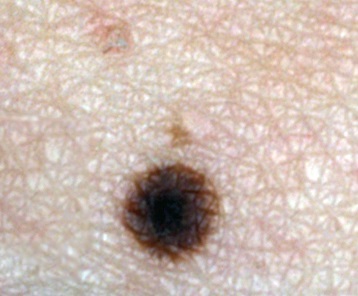 Skin Cancers and Lesions – The Skin Cancer Doctor